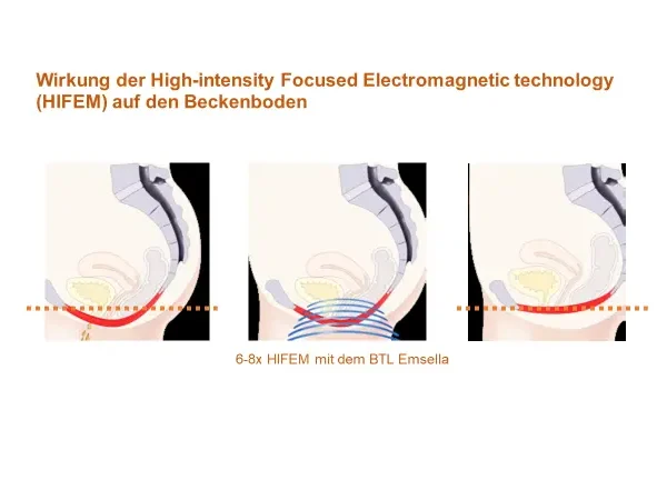 Der BTL Emsella stuhl | SGN Berlin
